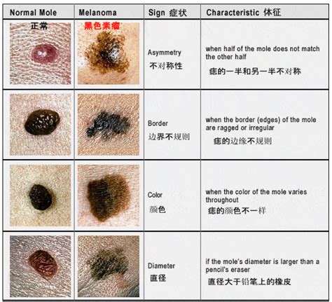 痣變色|痣變異：中間變色、周圍淡化，是否需要就醫？